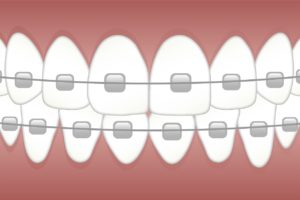 braces, teeth, dentist-3597591.jpg